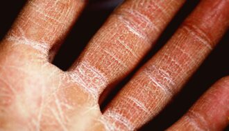 How Do I Know If I Have Eczema