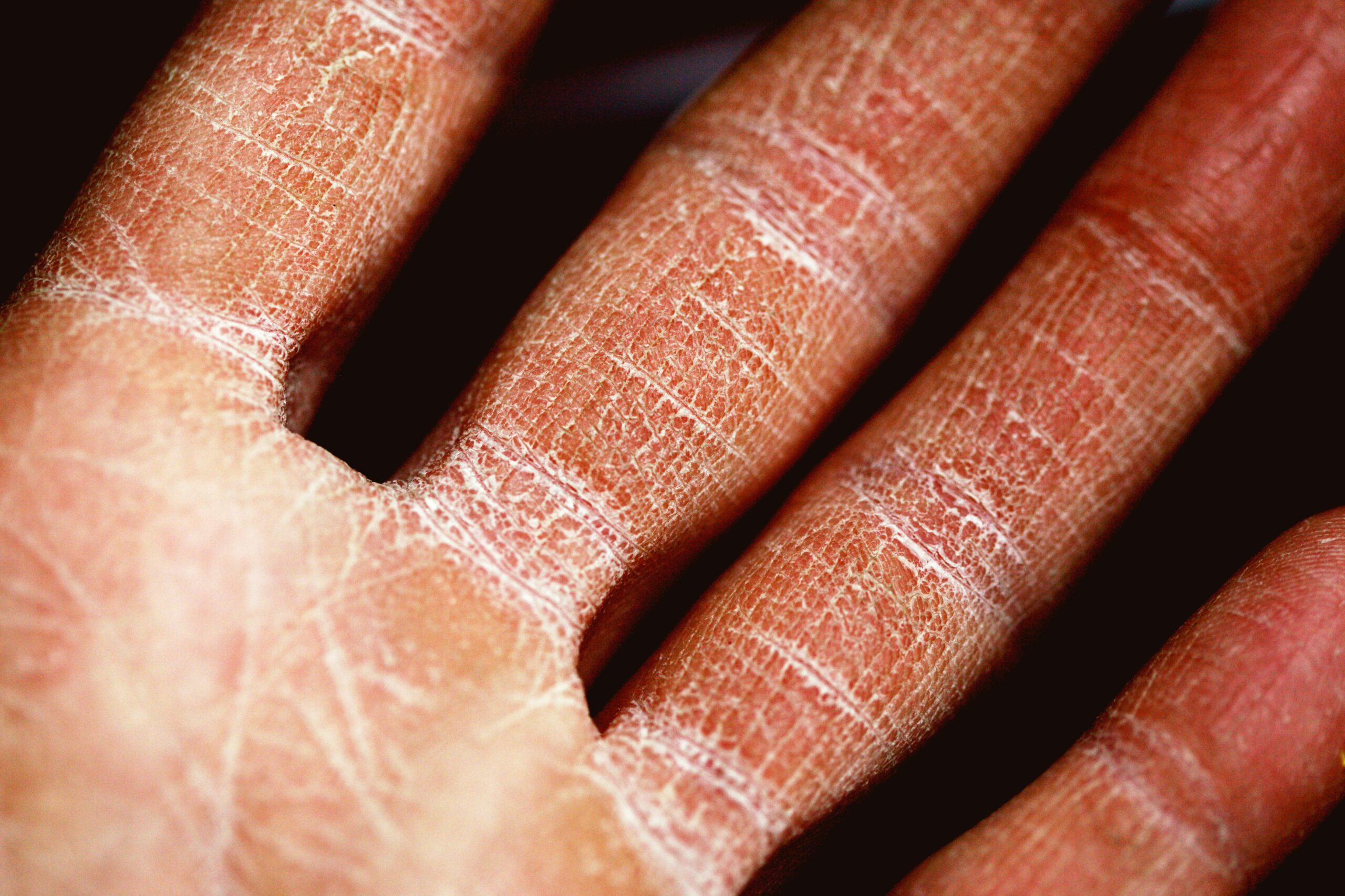 How Do I Know If I Have Eczema